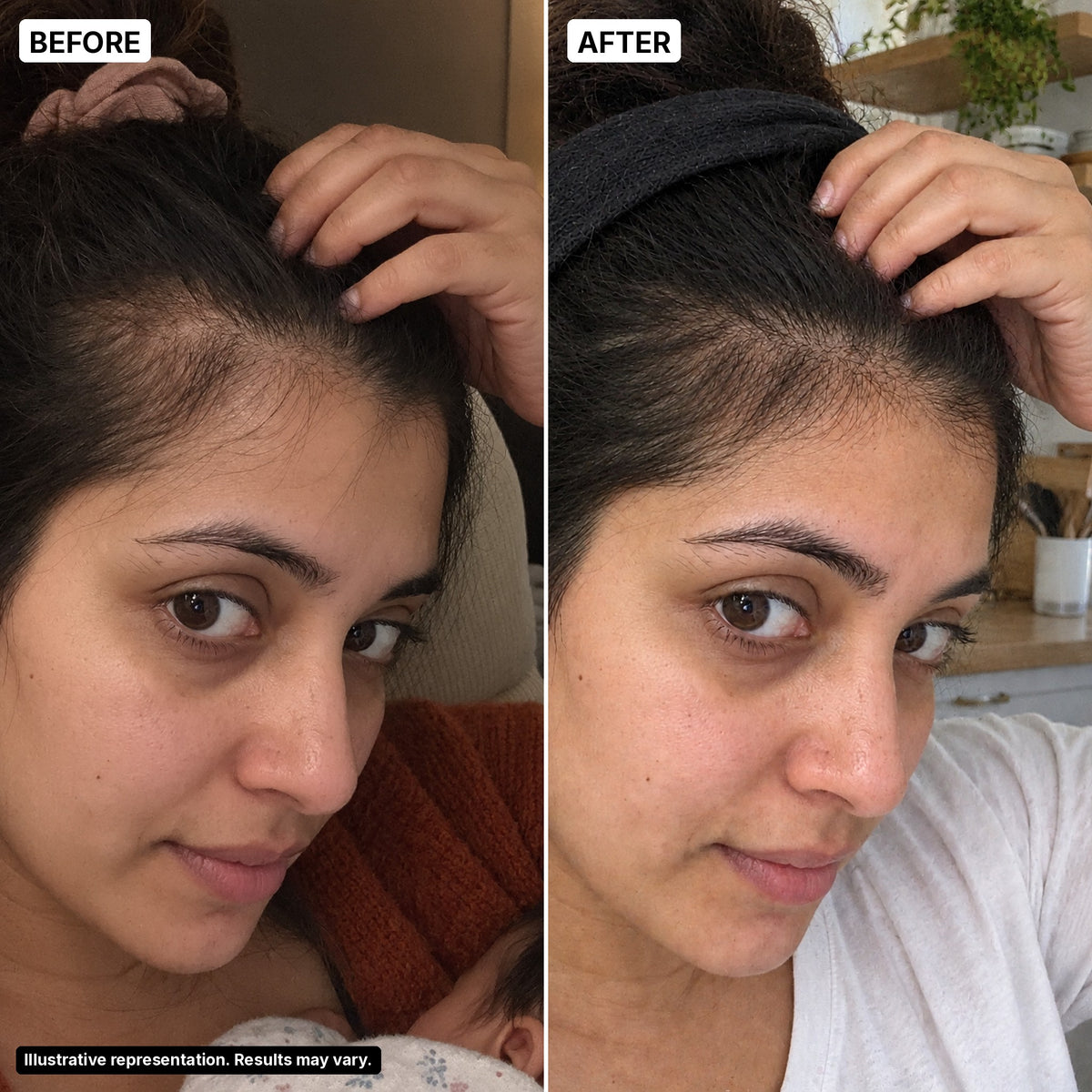 Before and after – hairline, postpartum mom 33, illustrative representation